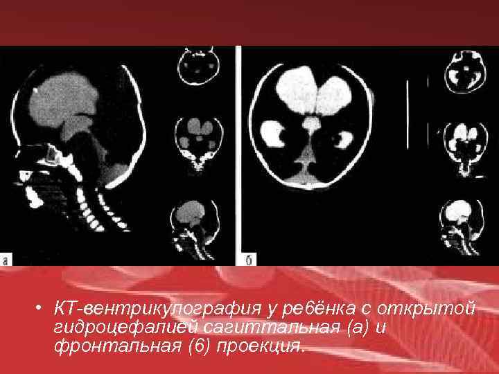  • КТ-вентрикулография у ре 6ёнка с открытой гидроцефалией сагиттальная (а) и фронтальная (6)