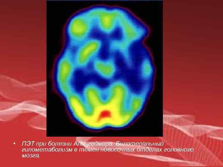  • ПЭТ при болезни Альцгеймера. Билатеральный гипометаболизм в темен новисочных отделах головного мозга.