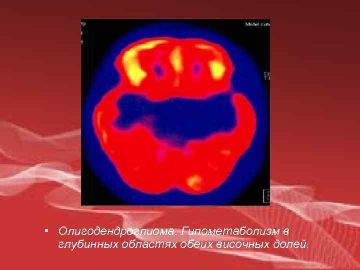  • Олигодендроглиома. Гипометаболизм в глубинных областях обеих височных долей. 