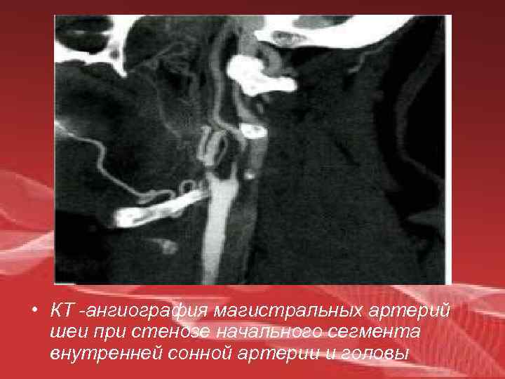  • КТ -ангиография магистральных артерий шеи при стенозе начального сегмента внутренней сонной артерии