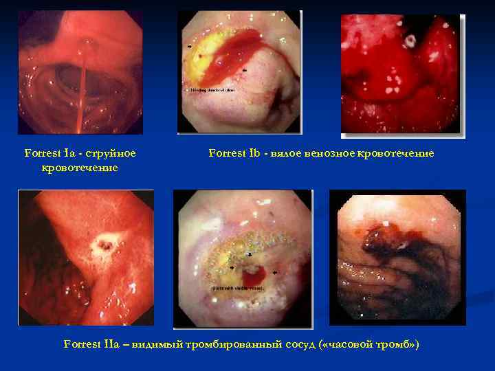 Forrest Ia - струйное кровотечение Forrest Ib - вялое венозное кровотечение Forrest IIa –