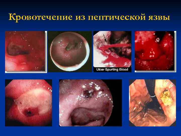 Кровотечение из пептической язвы 