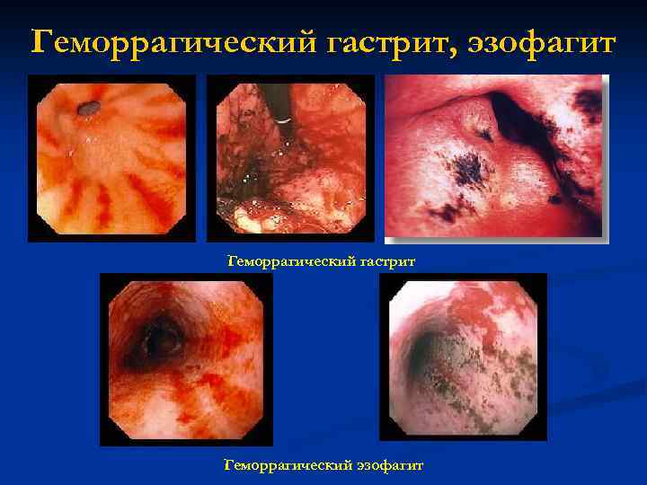 Геморрагический гастрит, эзофагит Геморрагический гастрит Геморрагический эзофагит 