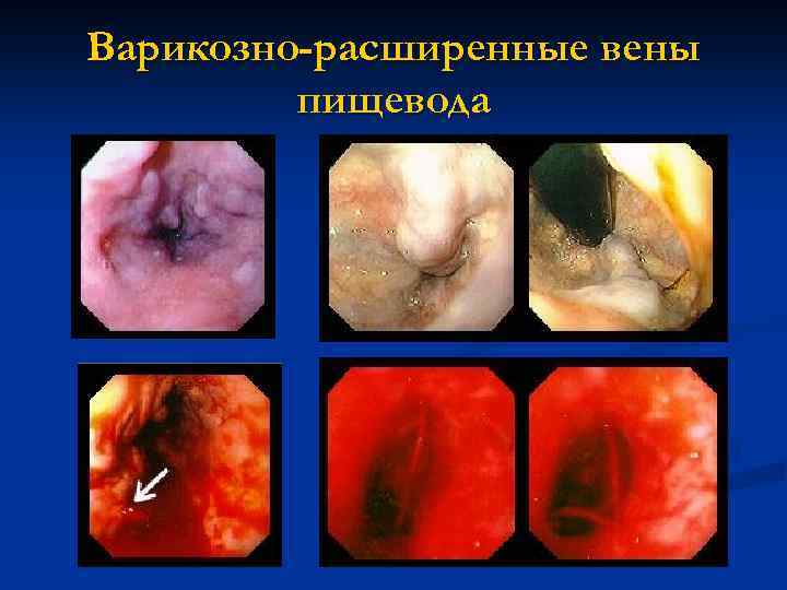 Варикозно-расширенные вены пищевода 