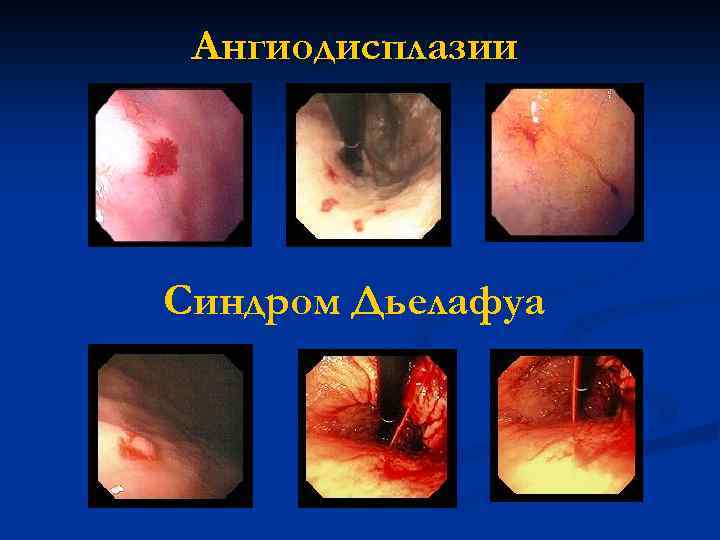 Ангиодисплазии Синдром Дьелафуа 