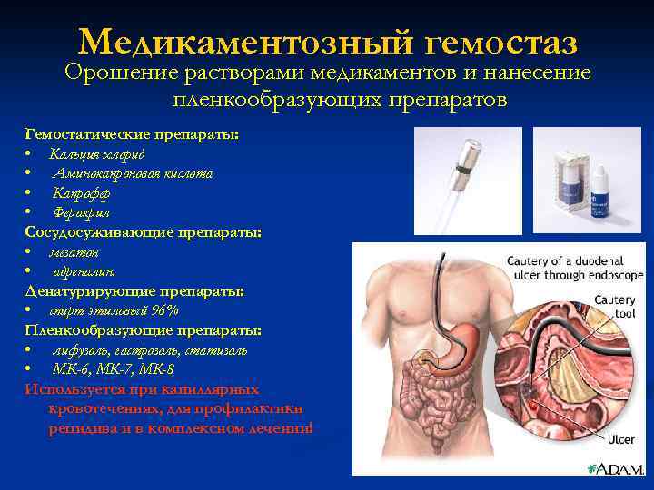 Медикаментозный гемостаз Орошение растворами медикаментов и нанесение пленкообразующих препаратов Гемостатические препараты: • Кальция хлорид