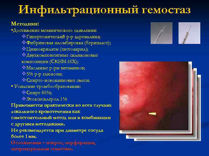 Инфильтрационный гемостаз Методики: • Достижение механического сдавления: v. Гипертонический р-р адреналина; v. Фибриновая пломбировка