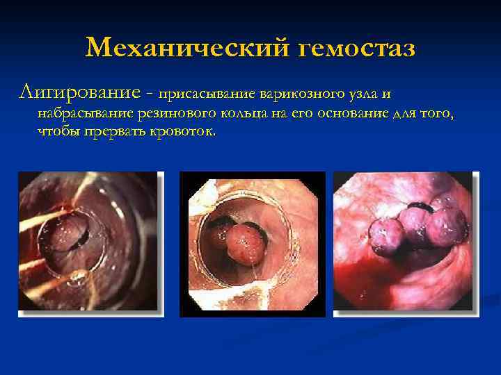 Механический гемостаз Лигирование - присасывание варикозного узла и набрасывание резинового кольца на его основание