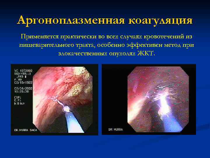 Аргоноплазменная коагуляция Применяется практически во всех случаях кровотечений из пищеварительного тракта, особенно эффективен метод