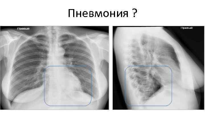 Пневмония ? 