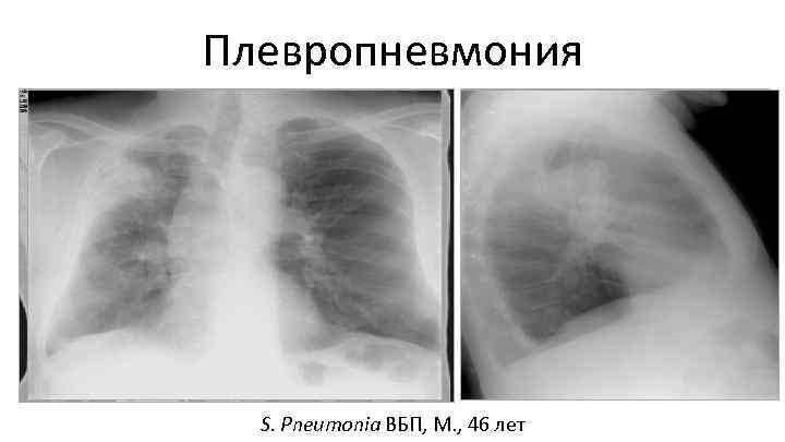 Плевропневмония S. Pneumonia ВБП, М. , 46 лет 