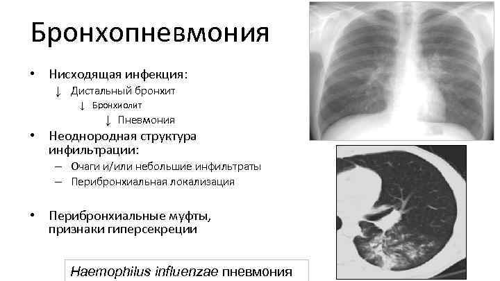 Бронхопневмония • Нисходящая инфекция: ↓ Дистальный бронхит ↓ Бронхиолит ↓ Пневмония • Неоднородная структура