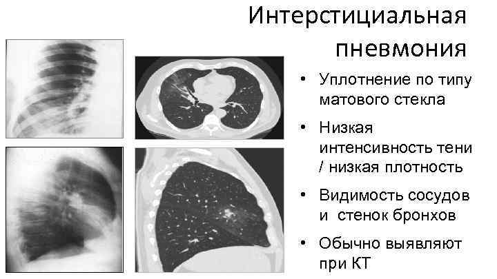 Интерстициальная пневмония • Уплотнение по типу матового стекла • Низкая интенсивность тени / низкая