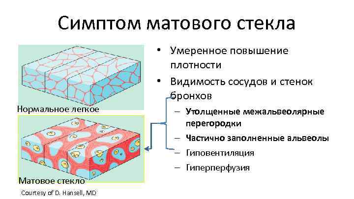 Симптом матового стекла • Умеренное повышение плотности • Видимость сосудов и стенок бронхов Нормальное