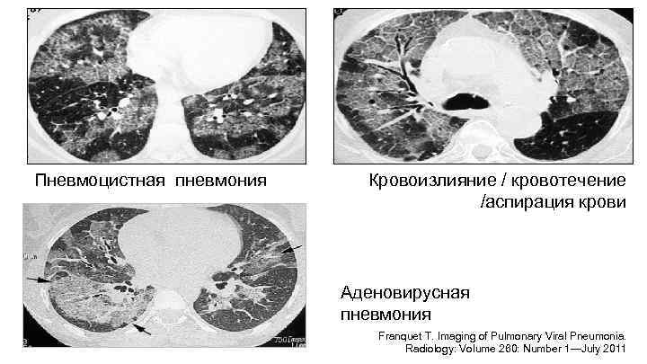 Пневмоцистная пневмония Кровоизлияние / кровотечение /аспирация крови Аденовирусная пневмония Franquet T. Imaging of Pulmonary