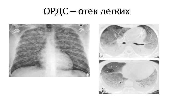 ОРДС – отек легких 