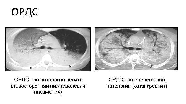 ОРДС при патологии легких (левосторонняя нижнедолевая пневмония) ОРДС при внелегочной патологии (о. панкреатит) 