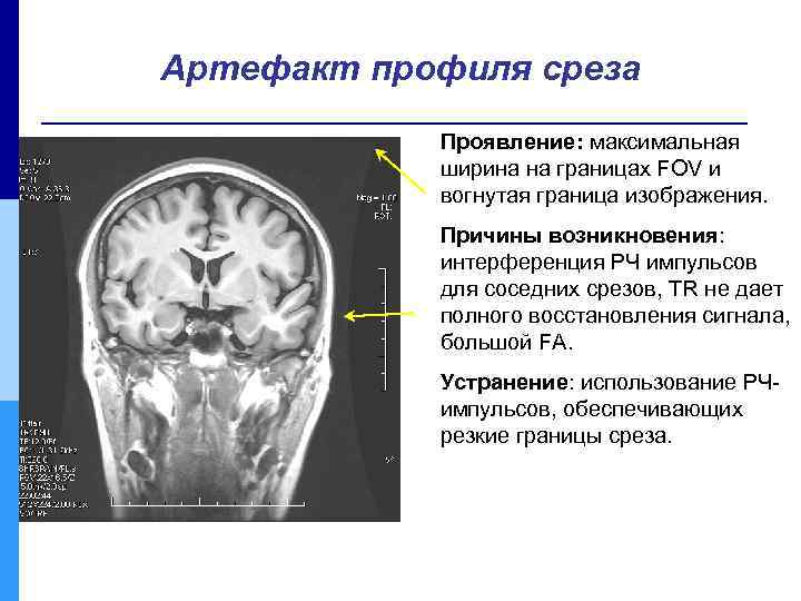 Артефакт профиля среза Проявление: максимальная ширина на границах FOV и вогнутая граница изображения. Причины