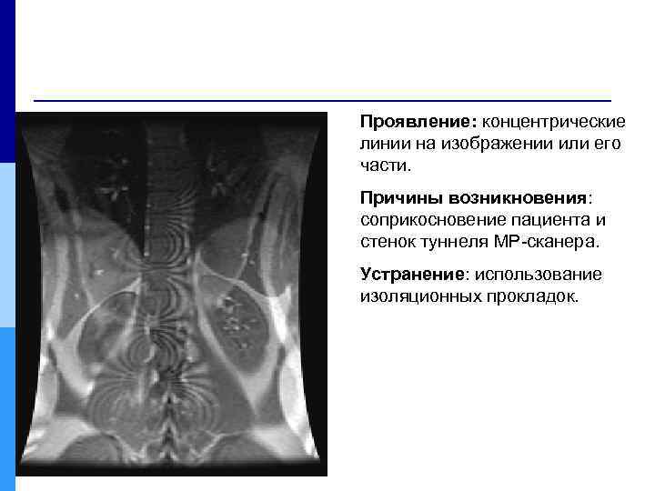 Проявление: концентрические линии на изображении или его части. Причины возникновения: соприкосновение пациента и стенок