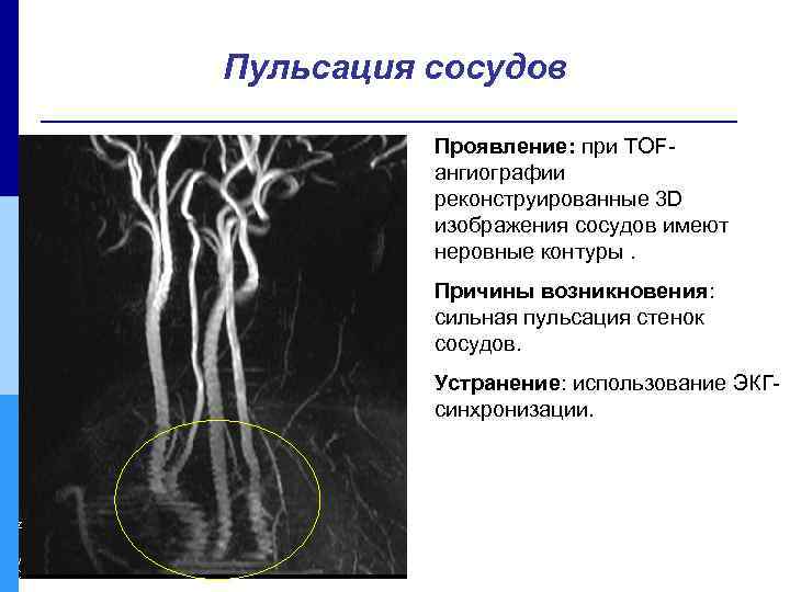 Пульсация сосудов Проявление: при TOFангиографии реконструированные 3 D изображения сосудов имеют неровные контуры. Причины