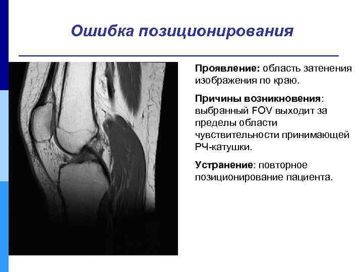 Ошибка позиционирования Проявление: область затенения изображения по краю. Причины возникновения: выбранный FOV выходит за