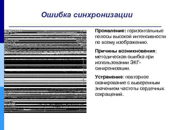 Ошибка синхронизации Проявление: горизонтальные полосы высокой интенсивности по всему изображению. Причины возникновения: методическая ошибка