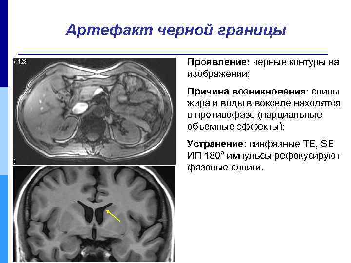 Артефакт черной границы Проявление: черные контуры на изображении; Причина возникновения: спины жира и воды