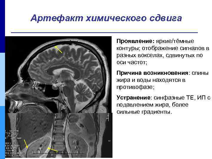 Артефакт химического сдвига Проявление: яркие/тёмные контуры; отображение сигналов в разных вокселах, сдвинутых по оси