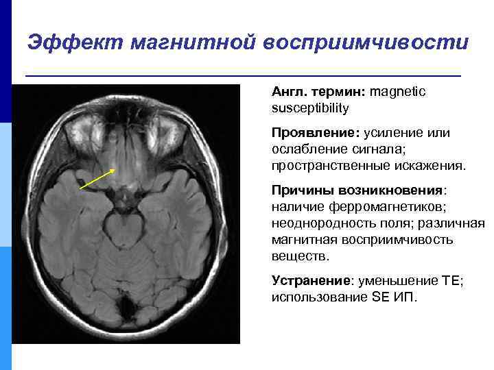 Эффект магнитной восприимчивости Англ. термин: magnetic susceptibility Проявление: усиление или ослабление сигнала; пространственные искажения.