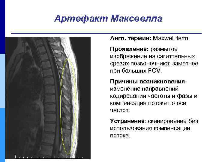 Артефакт Максвелла Англ. термин: Maxwell term Проявление: размытое изображение на сагиттальных срезах позвоночника; заметнее