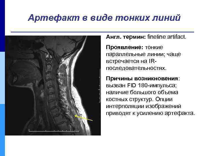 Артефакт в виде тонких линий Англ. термин: fineline artifact. Проявление: тонкие параллельные линии; чаще