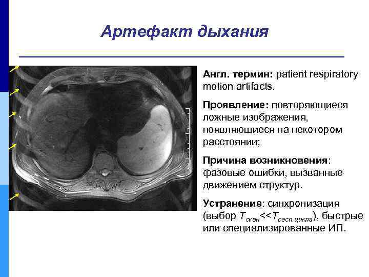 Артефакт дыхания Англ. термин: patient respiratory motion artifacts. Проявление: повторяющиеся ложные изображения, появляющиеся на