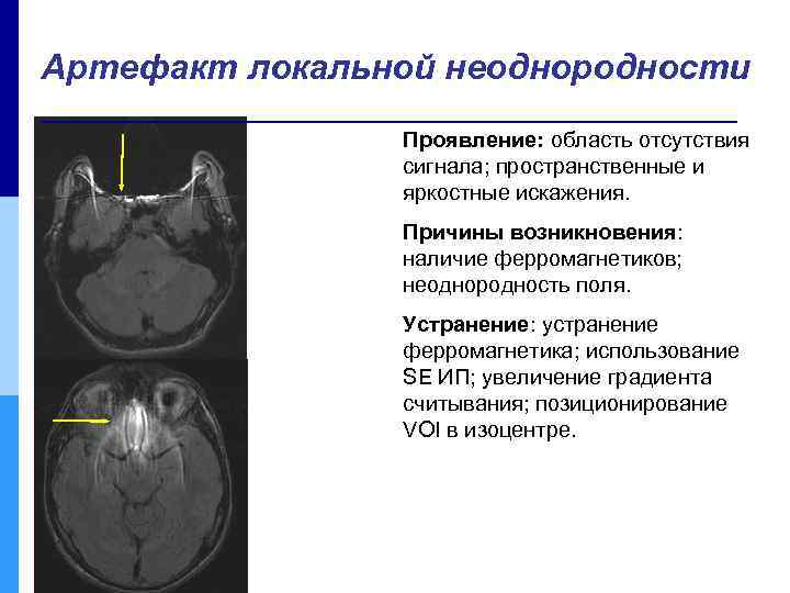 Артефакт локальной неоднородности Проявление: область отсутствия сигнала; пространственные и яркостные искажения. Причины возникновения: наличие