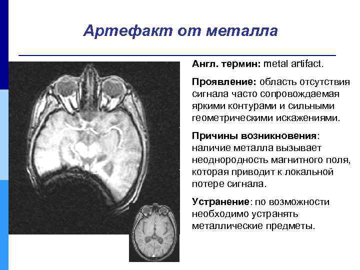 Артефакт от металла Англ. термин: metal artifact. Проявление: область отсутствия сигнала часто сопровождаемая яркими