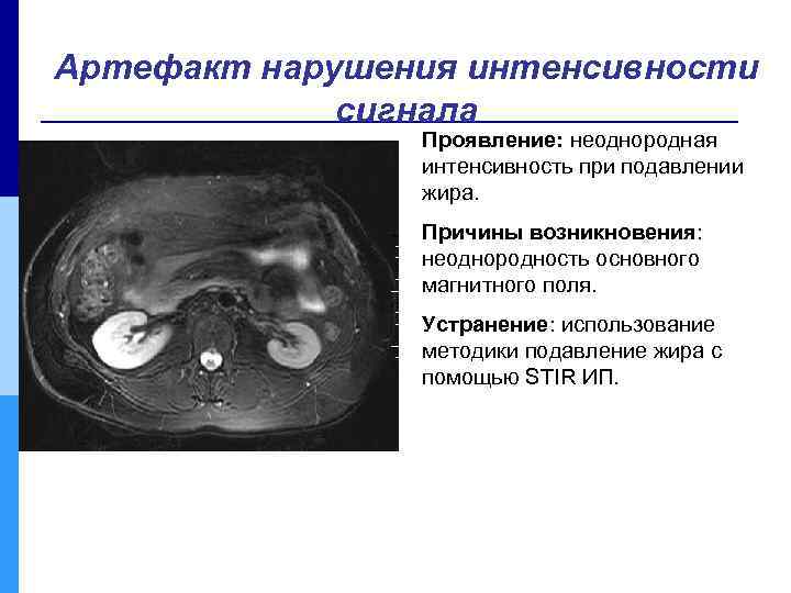 Артефакт нарушения интенсивности сигнала Проявление: неоднородная интенсивность при подавлении жира. Причины возникновения: неоднородность основного
