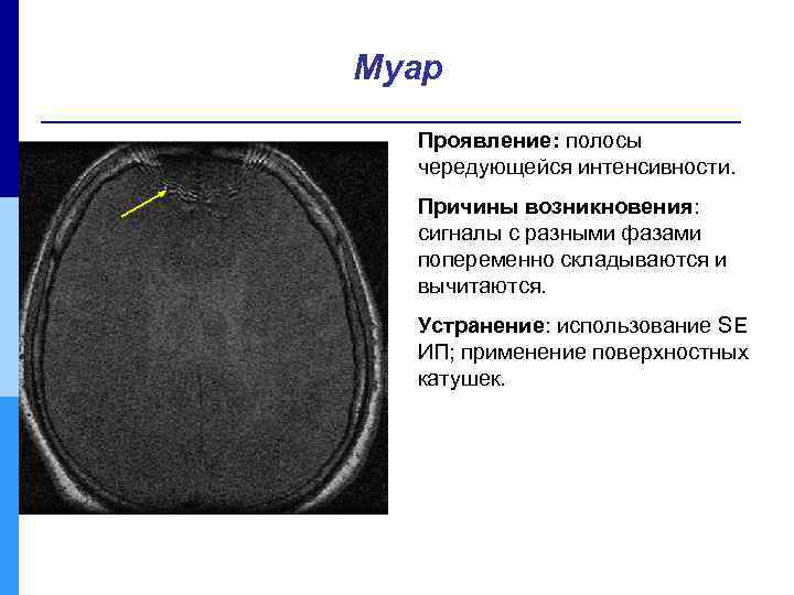 Муар Проявление: полосы чередующейся интенсивности. Причины возникновения: сигналы с разными фазами попеременно складываются и