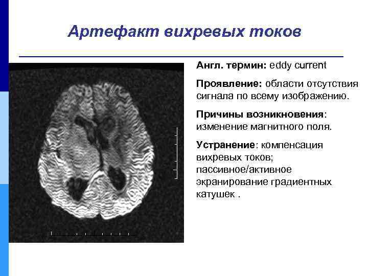 Артефакт вихревых токов Англ. термин: eddy current Проявление: области отсутствия сигнала по всему изображению.