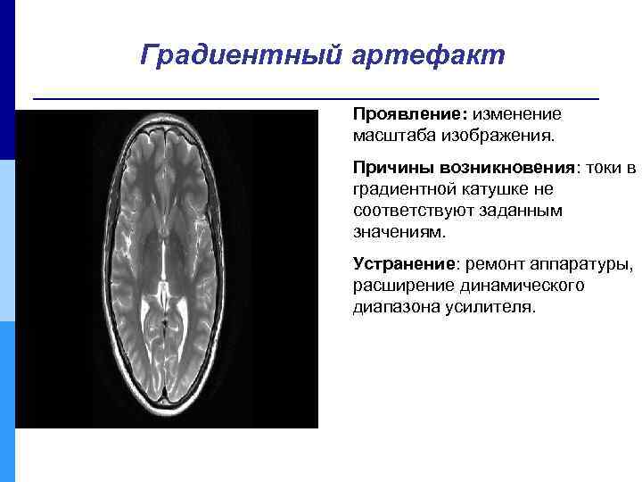 Градиентный артефакт Проявление: изменение масштаба изображения. Причины возникновения: токи в градиентной катушке не соответствуют