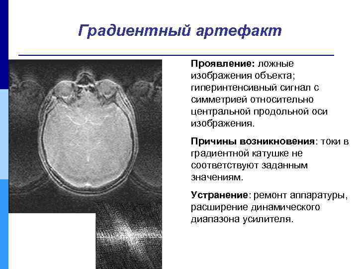 Градиентный артефакт Проявление: ложные изображения объекта; гиперинтенсивный сигнал с симметрией относительно центральной продольной оси