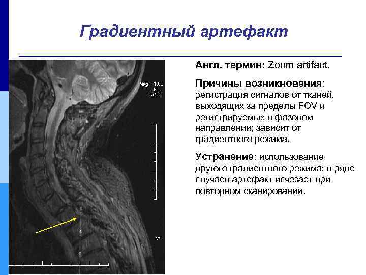 Градиентный артефакт Англ. термин: Zoom artifact. Причины возникновения: регистрация сигналов от тканей, выходящих за