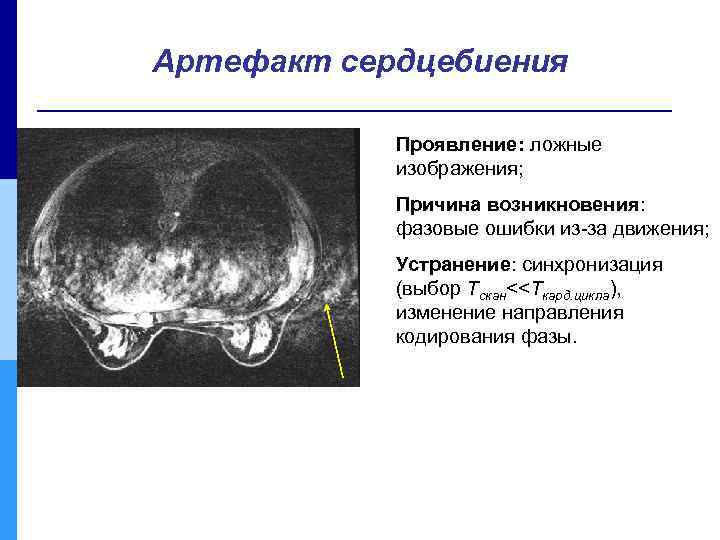 Артефакт сердцебиения Проявление: ложные изображения; Причина возникновения: фазовые ошибки из-за движения; Устранение: синхронизация (выбор