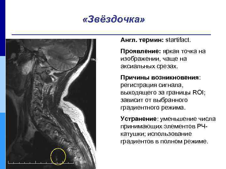  «Звёздочка» Англ. термин: startifact. Проявление: яркая точка на изображении, чаще на аксиальных срезах.