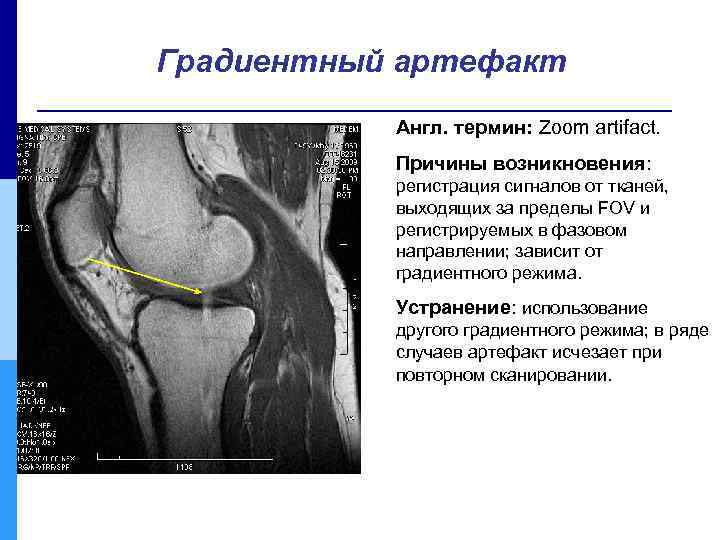 Градиентный артефакт Англ. термин: Zoom artifact. Причины возникновения: регистрация сигналов от тканей, выходящих за