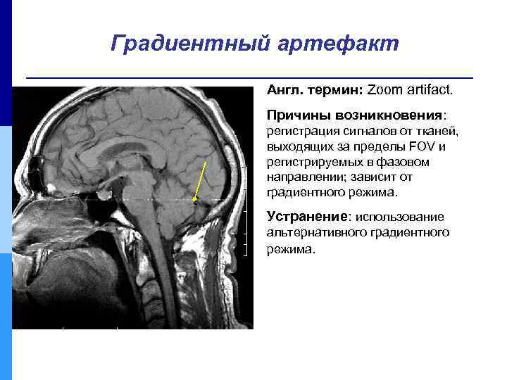 Градиентный артефакт Англ. термин: Zoom artifact. Причины возникновения: регистрация сигналов от тканей, выходящих за