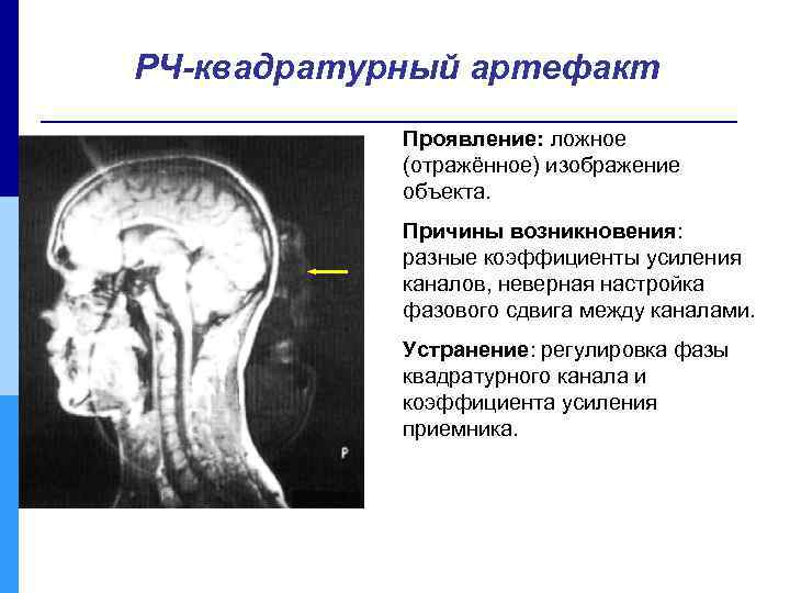 РЧ-квадратурный артефакт Проявление: ложное (отражённое) изображение объекта. Причины возникновения: разные коэффициенты усиления каналов, неверная