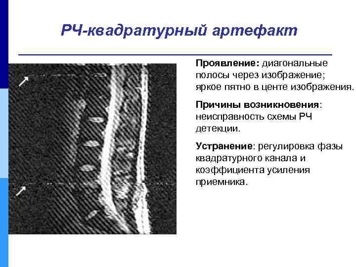 РЧ-квадратурный артефакт Проявление: диагональные полосы через изображение; яркое пятно в центе изображения. Причины возникновения: