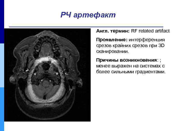 РЧ артефакт Англ. термин: RF related artifact Проявление: интерференция срезов крайних срезов при 3