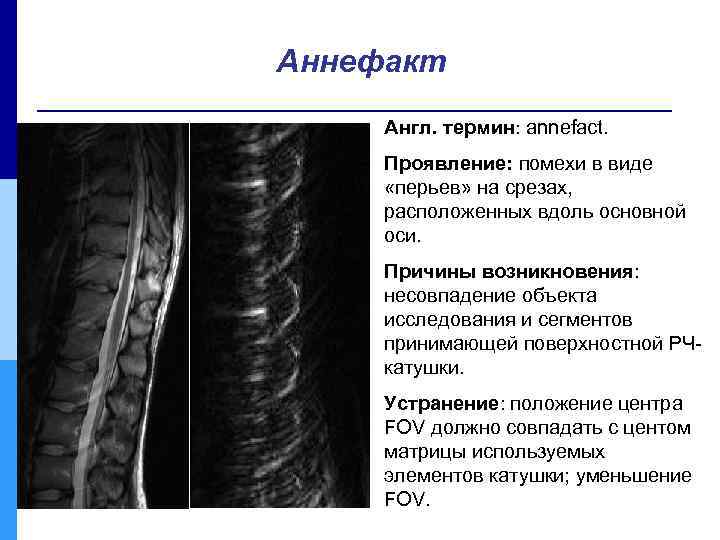 Аннефакт Англ. термин: annefact. Проявление: помехи в виде «перьев» на срезах, расположенных вдоль основной