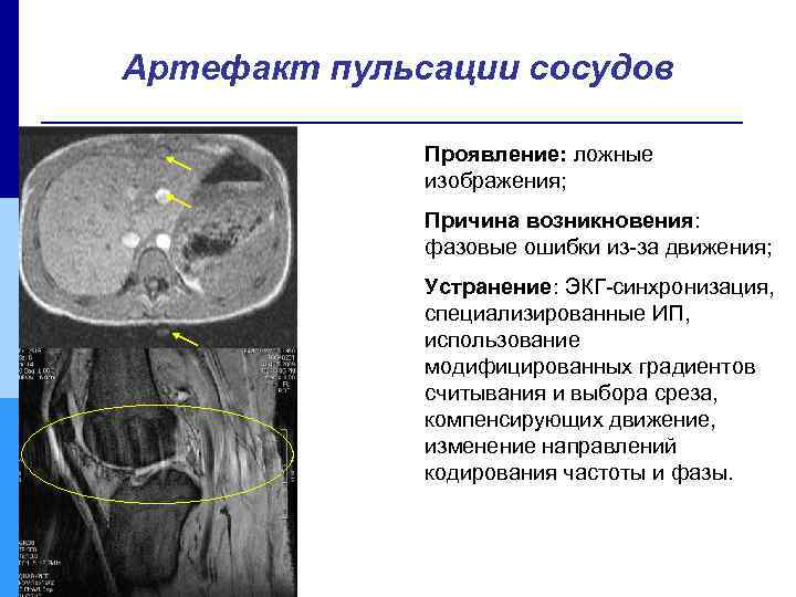 Артефакт пульсации сосудов Проявление: ложные изображения; Причина возникновения: фазовые ошибки из-за движения; Устранение: ЭКГ-синхронизация,