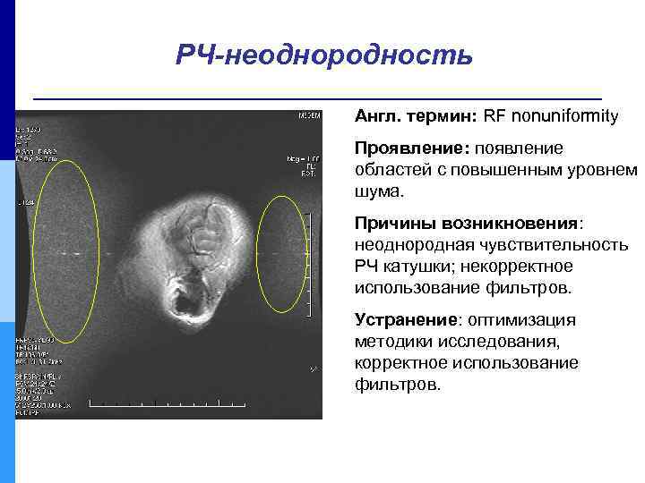 РЧ-неоднородность Англ. термин: RF nonuniformity Проявление: появление областей с повышенным уровнем шума. Причины возникновения: